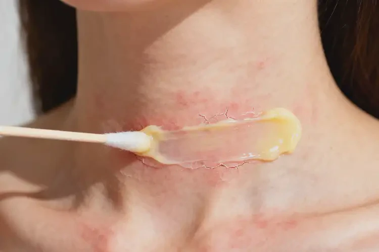 女人脖子上經(jīng)常長濕疹能夠徹底治愈嗎(圖1)