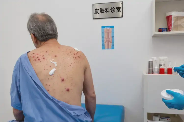 男性屁股上出濕疹能靠自己自愈嗎(圖2)