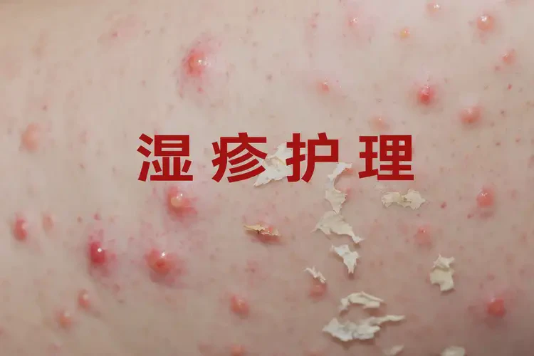 嬰幼兒大腿容易長濕疹能靠自己自愈嗎(圖3)