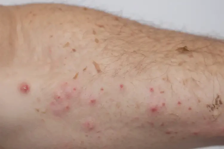 小孩脖子偶爾起濕疹可以徹底自愈嗎(圖3)