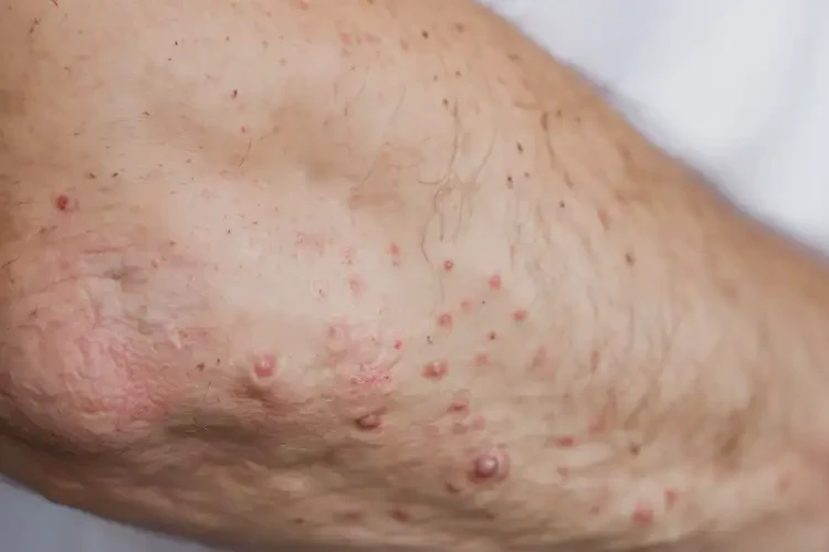 男性手臂偶爾起濕疹不管它會(huì)自己痊愈嗎(圖4)