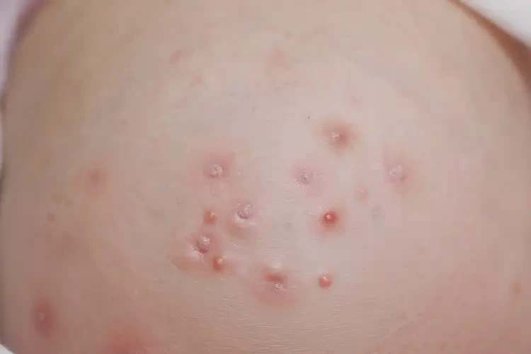 新生兒肛周經(jīng)常起濕疹可不可以徹底自愈(圖4)