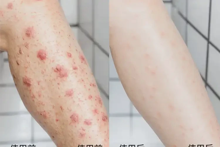 老人小腿經(jīng)常起濕疹能徹底自愈嗎(圖2)