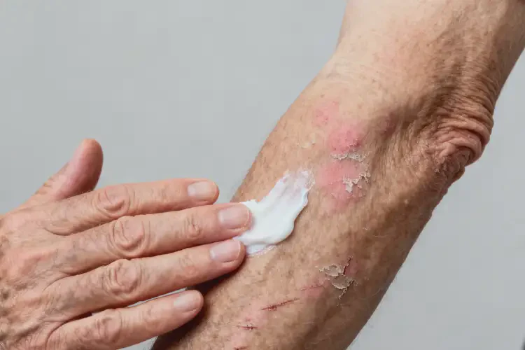 老年人手臂上出現(xiàn)濕疹不管它會自己自愈嗎(圖3)