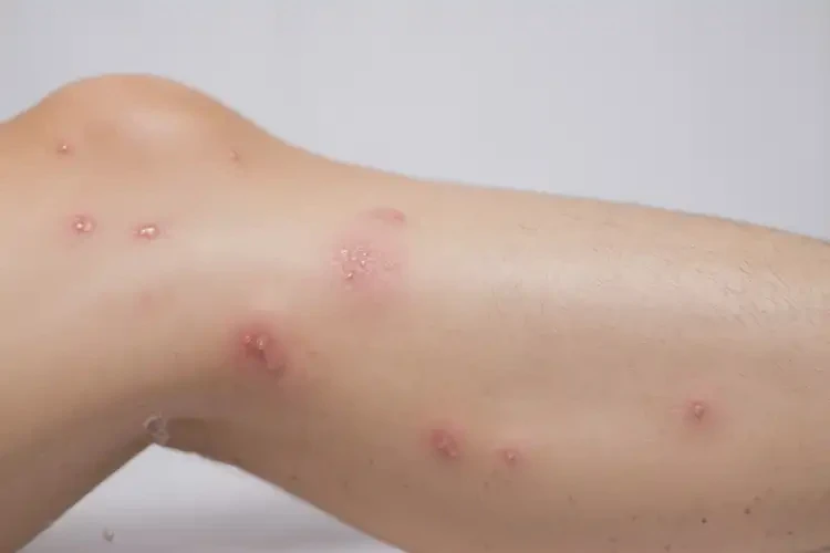 男人小腿容易長濕疹可不可以徹底自愈(圖4)