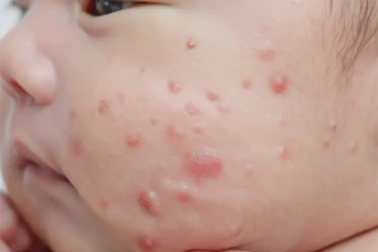 新生兒四肢容易長(zhǎng)濕疹能靠自己自愈嗎(圖4)