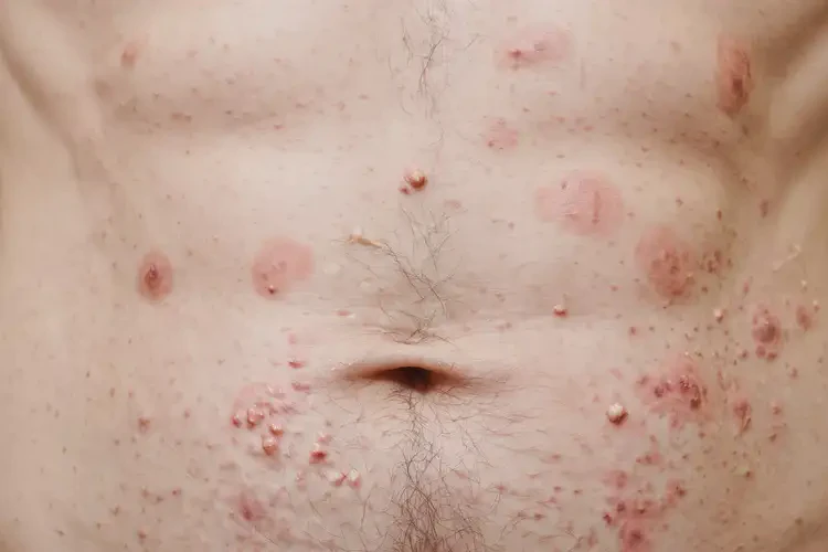 男性肚子經(jīng)常起濕疹可不可以徹底自愈(圖4)