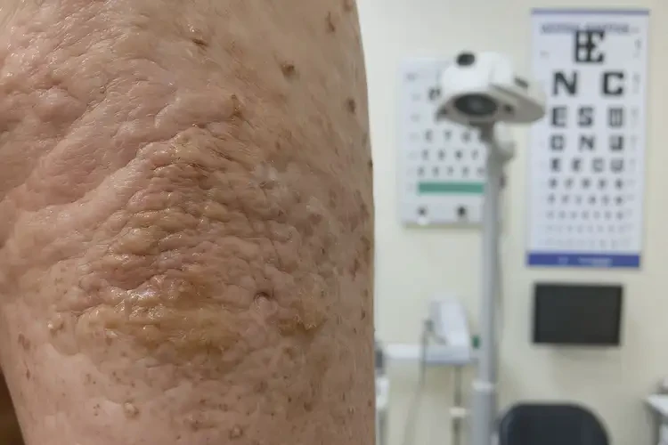 青年人小腿偶爾起濕疹可以徹底自愈嗎(圖1)