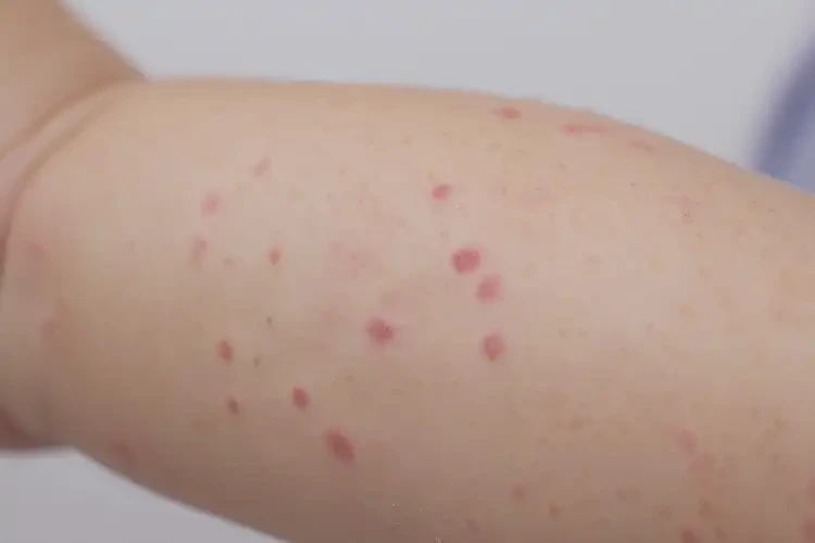 幼兒手臂有濕疹不管它會自己好嗎(圖4)