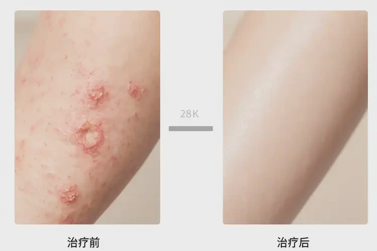 哺乳期媽媽手臂長濕疹不管它會自己好嗎(圖3)