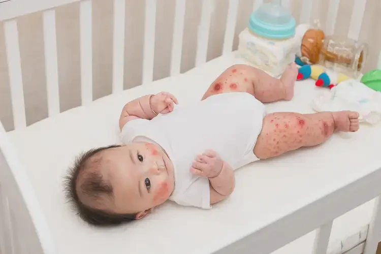 孩子肚子上出濕疹能靠自己自愈嗎(圖3)