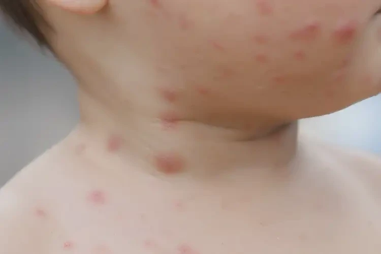 小孩脖子偶爾起濕疹可以徹底自愈嗎(圖4)