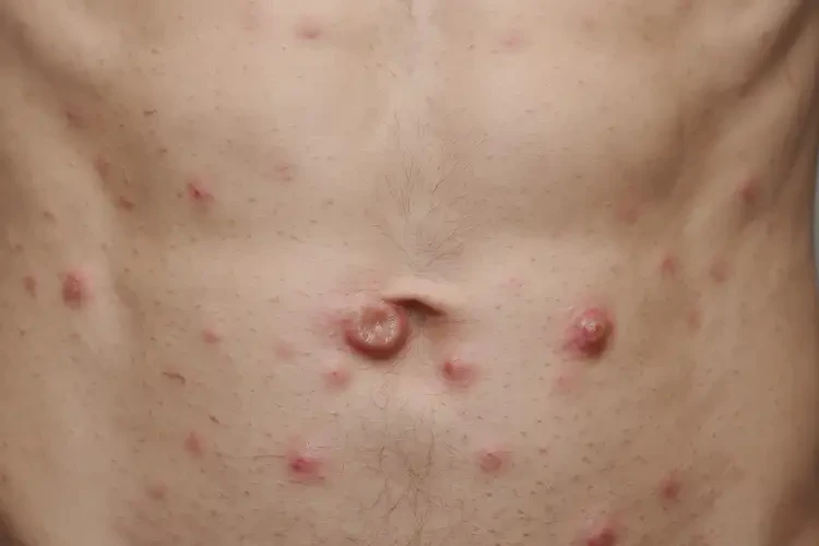 青年人肚子上出濕疹可以徹底自愈嗎(圖4)