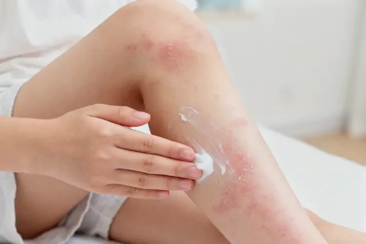 少兒小腿上有濕疹不管它會(huì)自己自愈嗎(圖3)