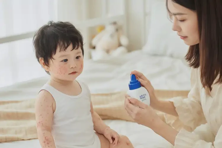 幼兒肚子上容易長濕疹能徹底自愈嗎(圖3)