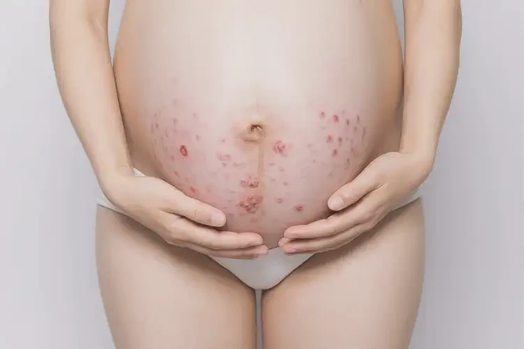 孕妇肛周有湿疹不管它会自己好吗(图4)