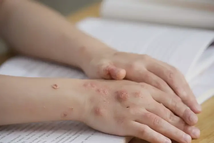 青少年手上有濕疹能徹底自愈嗎(圖4)