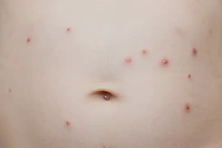 幼兒肚子上有濕疹能夠徹底治愈嗎(圖4)