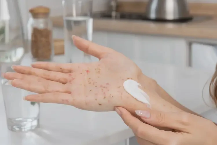 女性手上出現(xiàn)濕疹可不可以徹底自愈(圖2)