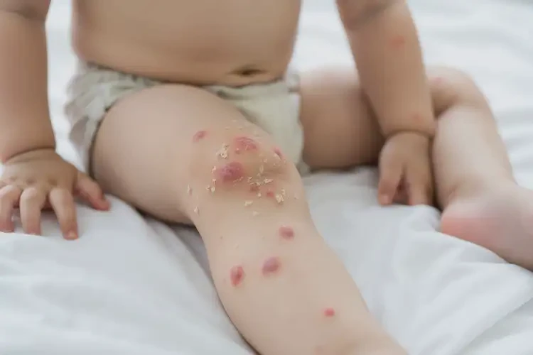 幼兒大腿上長濕疹不管它會自己痊愈嗎(圖4)