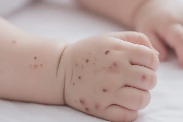 寶寶手上有濕疹不管它會自己痊愈嗎(圖4)