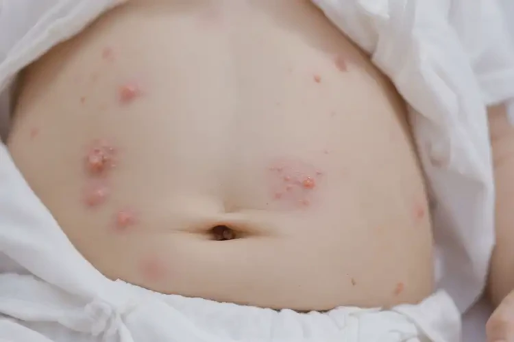 幼兒肚子上容易長濕疹能徹底自愈嗎(圖4)