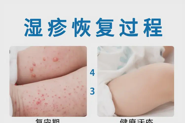 寶寶小腿有濕疹可以徹底自愈嗎(圖4)