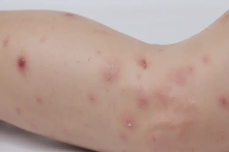 兒童小腿上長濕疹能徹底自愈嗎(圖4)