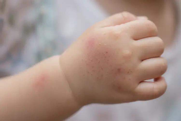 少兒手上偶爾起濕疹能靠自己自愈嗎(圖4)