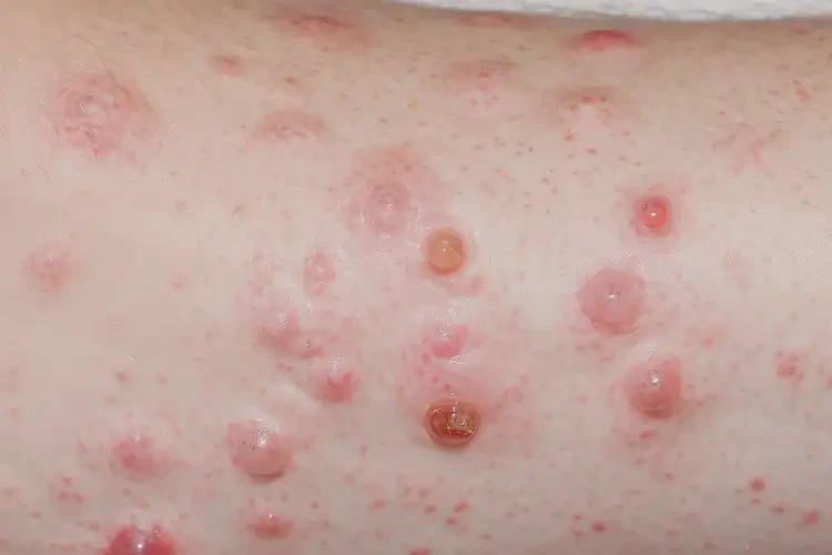 女人手臂上容易長濕疹能徹底自愈嗎(圖4)