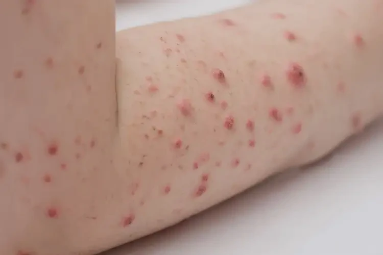 小兒四肢經(jīng)常起濕疹可不可以徹底自愈(圖4)