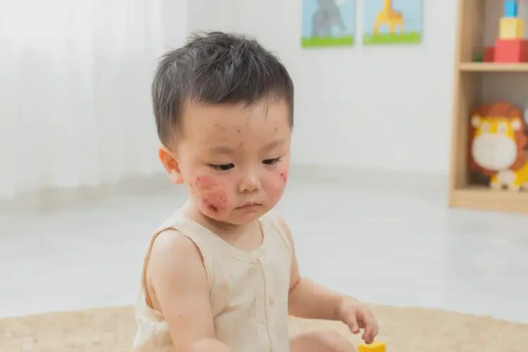 幼兒臉上偶爾起濕疹不管它會自己痊愈嗎(圖3)