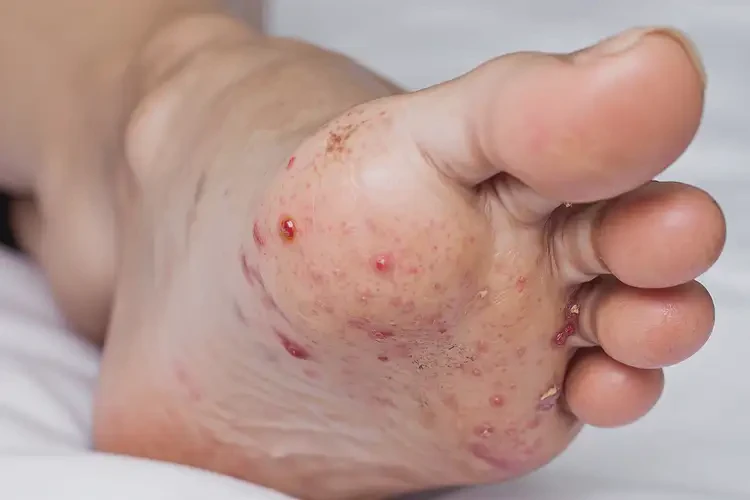 產(chǎn)婦腳上出濕疹不管它會自己痊愈嗎(圖4)