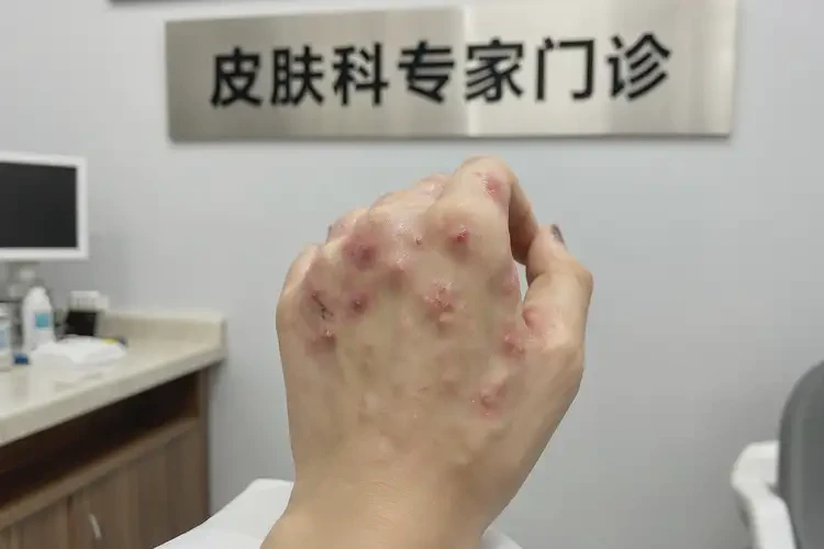 女性手上出現(xiàn)濕疹可不可以徹底自愈(圖3)