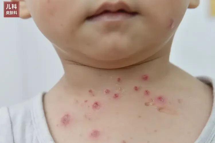 幼儿脖子上有湿疹不管它会自己自愈吗(图3)