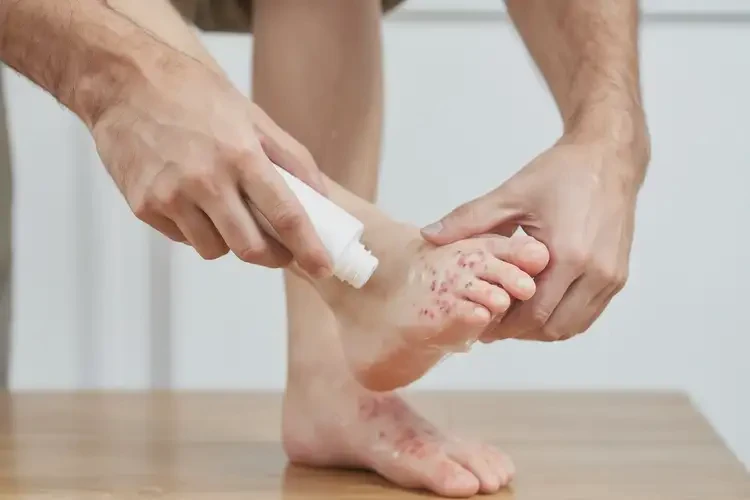 小孩腳上容易長濕疹能靠自己自愈嗎(圖1)