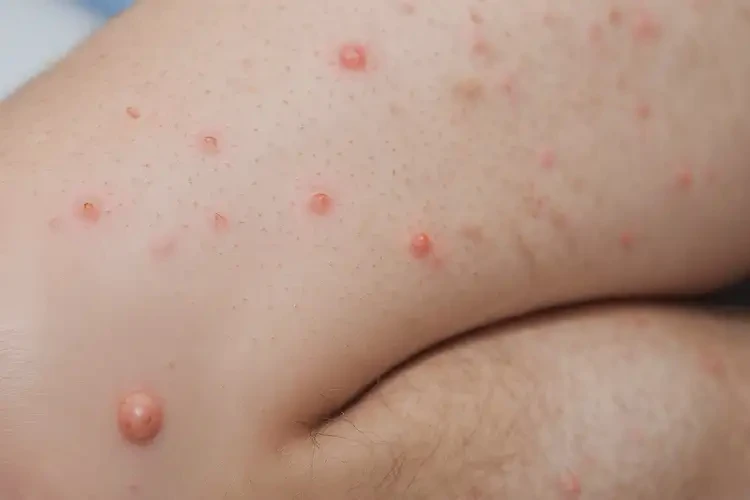 中學(xué)生小腿有濕疹可不可以徹底自愈(圖4)