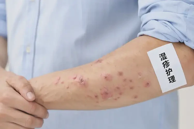 青年人手臂有湿疹不管它会自己自愈吗(图4)