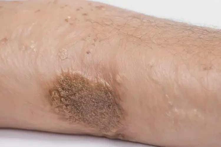 女人手臂上容易長濕疹能徹底自愈嗎(圖2)