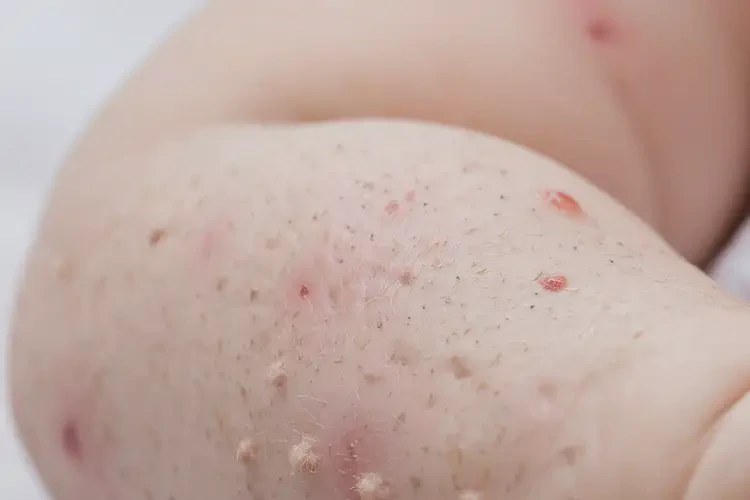 幼儿身上出湿疹能靠自己自愈吗(图4)