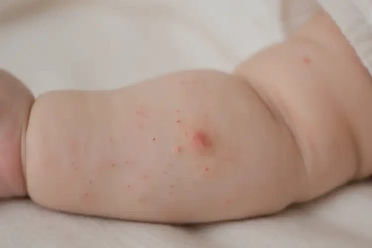 嬰幼兒手臂長(zhǎng)濕疹可不可以徹底自愈(圖4)