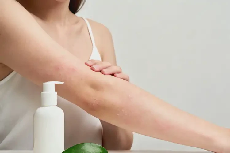 產(chǎn)婦手臂經(jīng)常長濕疹能徹底自愈嗎(圖2)