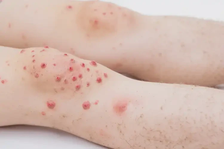 中學(xué)生小腿有濕疹可不可以徹底自愈(圖2)