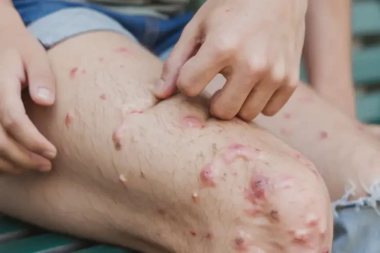 大學(xué)生大腿有濕疹不管它會(huì)自己痊愈嗎(圖4)