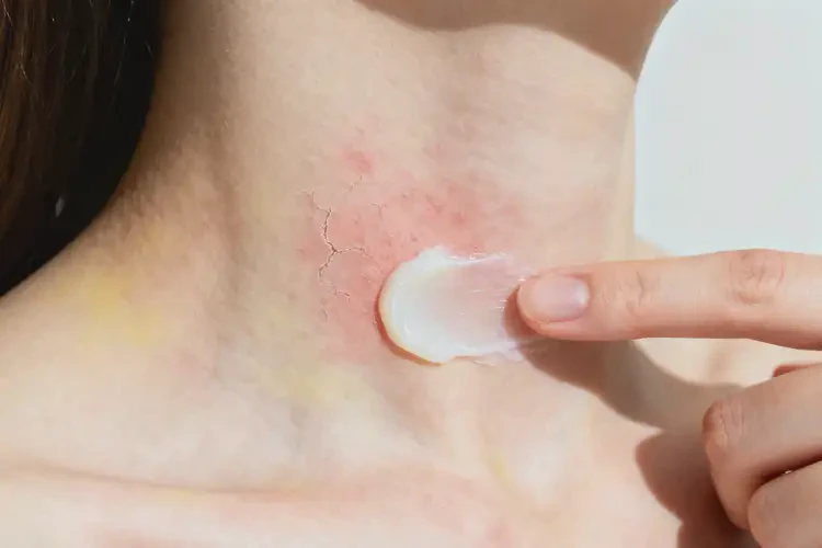 女人脖子上經(jīng)常長濕疹能夠徹底治愈嗎(圖4)