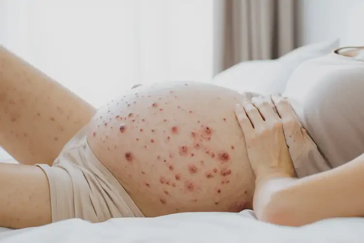 孕婦肚子起濕疹不管它會(huì)自己自愈嗎(圖4)