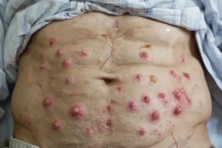 高齡老人肚子經(jīng)常長濕疹不管它會自己好嗎(圖4)