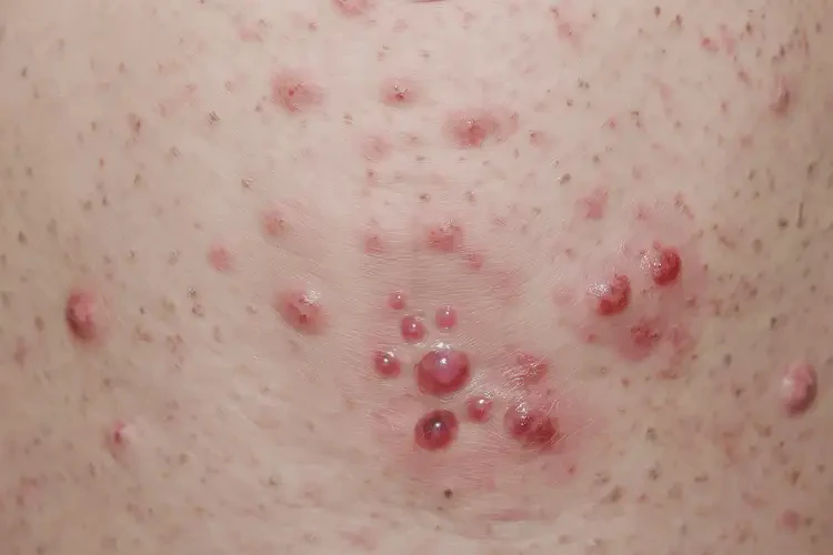 女性肛周偶爾起濕疹能徹底自愈嗎(圖4)