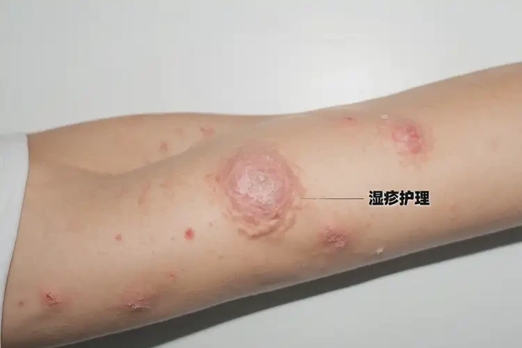 女人四肢容易長濕疹不管它會自己好嗎(圖4)