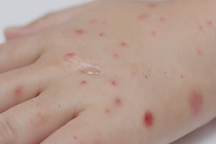 小兒手上出現(xiàn)濕疹能靠自己自愈嗎(圖4)